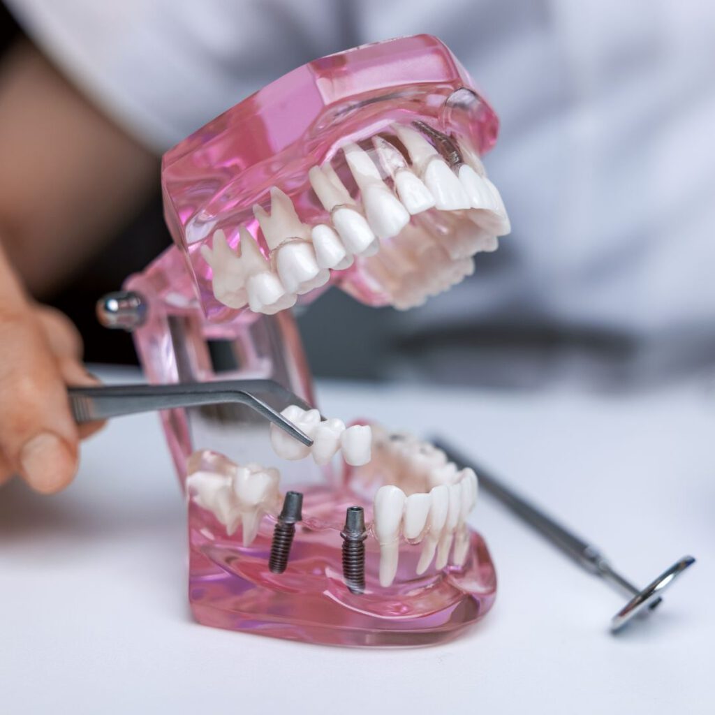 Mehrgliedriges Zahnimplantat wird in eine Kieferprothese gesetzt.