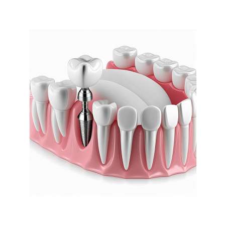 Bild eines Kiefermodells, auf dem ein einzelnes Zahnimplantat zu sehen ist, das einen fehlenden Zahn ersetzt. Das Implantat ist präzise in das Kiefermodell eingefügt und zeigt die hochwertige Einzelversorgung für ein ästhetisches und funktionales Ergebnis.