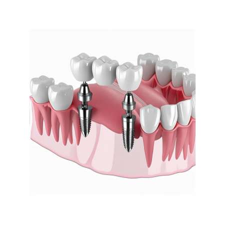 Bild eines Kiefermodells, auf dem ein mehrgliedriges Zahnimplantat zu sehen ist, das eine fehlende Zahnreihe ersetzt. Die Implantate sind präzise in das Kiefermodell eingefügt und zeigen die hochwertige mehrgliedrige Zahnversorgung für ein ästhetisches und funktionales Ergebnis.