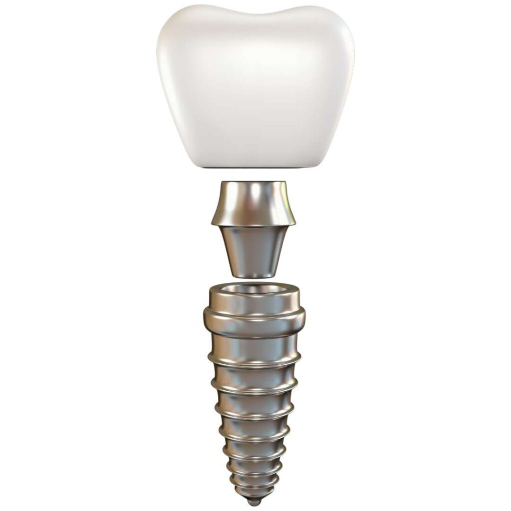 Zahnimplantat: Abbildung eines Zahnimplantats aus Titan in seinen einzelnen Bestandteilen. Unten der Implantatkörper, in der Mitte der Implantataufbau und oben die Implantatkrone.