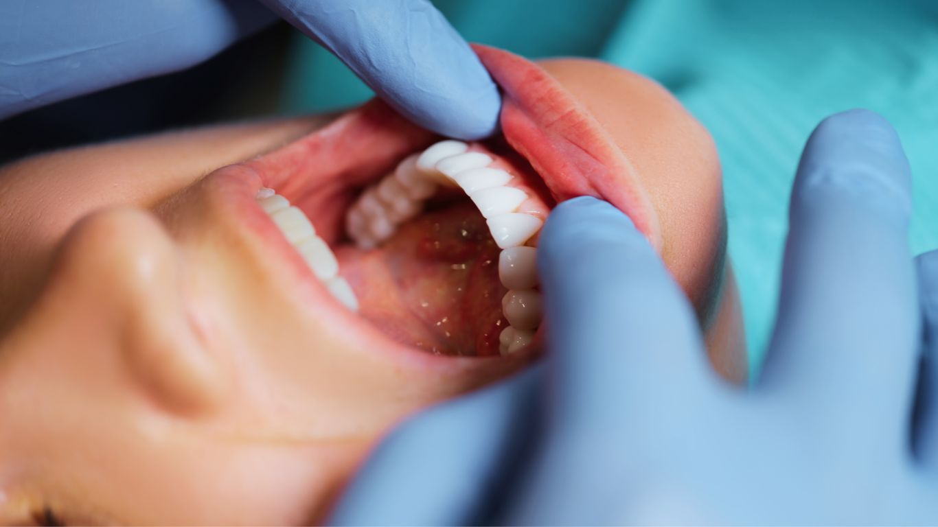 Eine Person wird vom Zahnarzt die Zähne begutachtet, nach einer oralchirurgischen Behandlung.