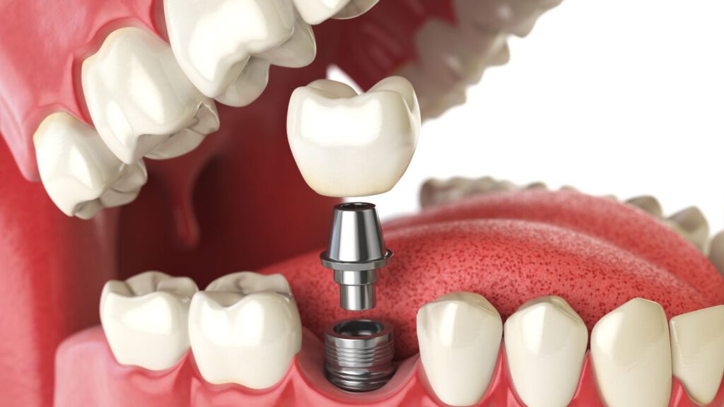 Detailaufnahme eines Gebisses mit herausragendem Zahnimplantat für perfekten Zahnersatz