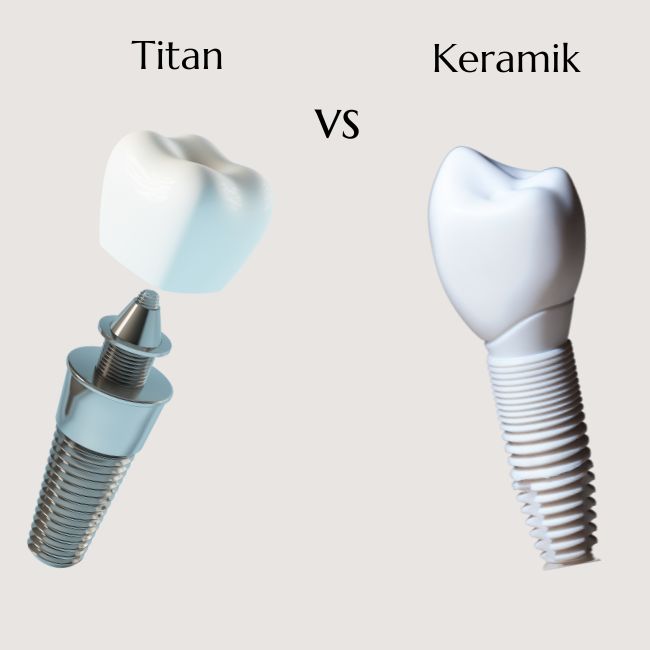 Vergleich zwischen einem Titan-Zahnimplantat und einem Keramik-Zahnimplantat, beide mit Krone.