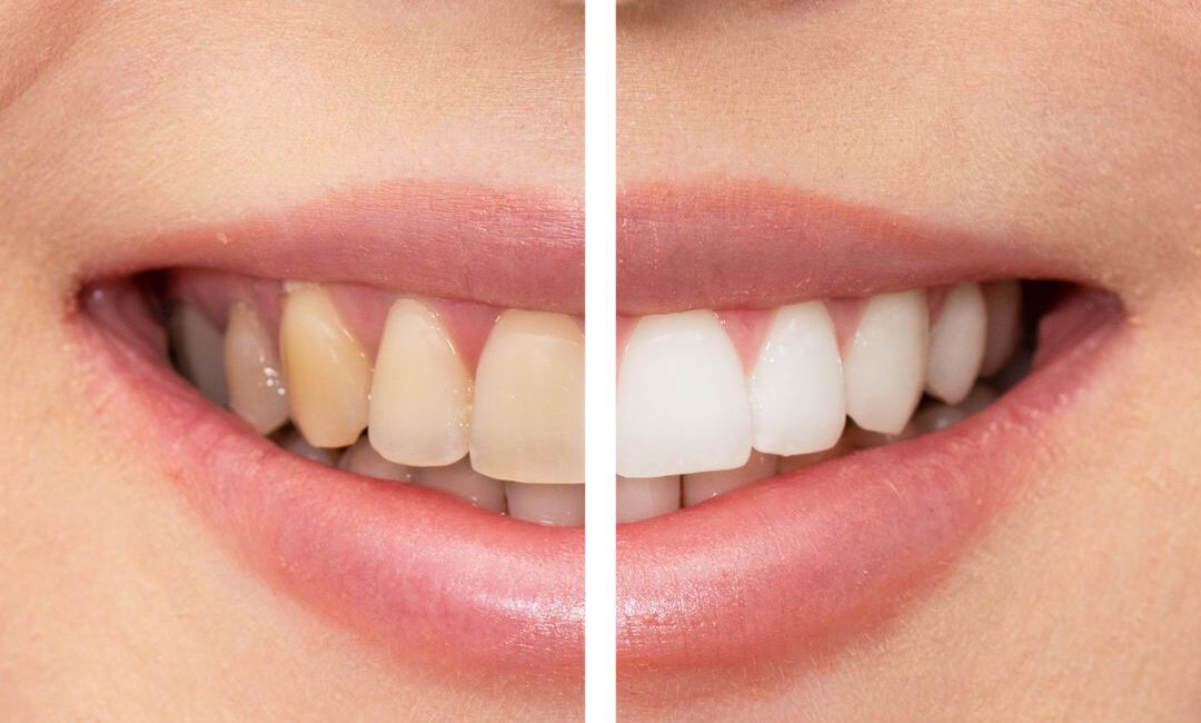 Vergleich des Lächelns vor und nach einer professionellen Zahnreinigung
