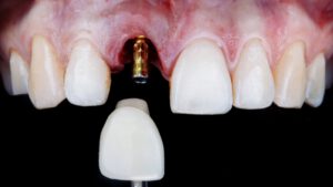 Nahaufnahme eines Zahns mit einem Zahnimplantat, das in das Zahnfleisch eingesetzt wird.