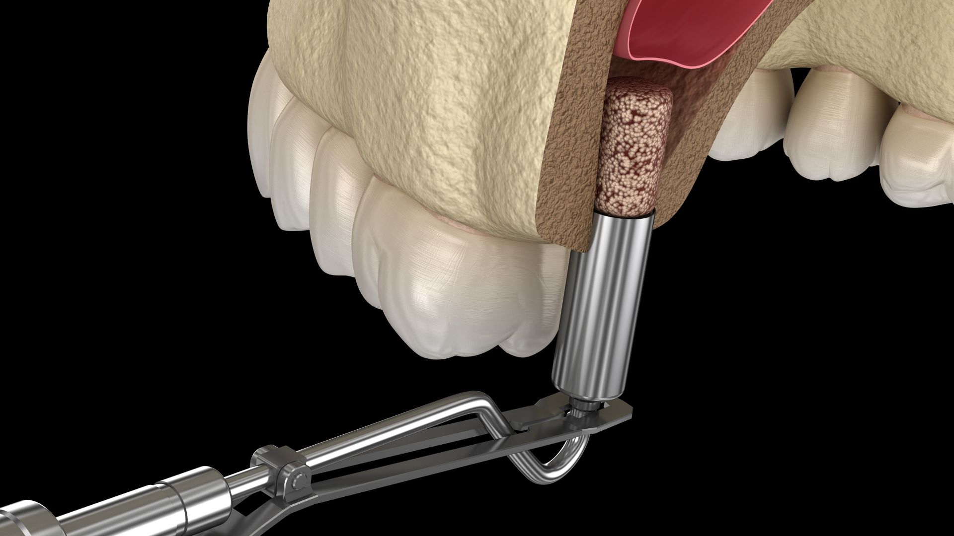 Illustration des Knochenaufbaus für ein Zahnimplantat mit chirurgischen Instrumenten.