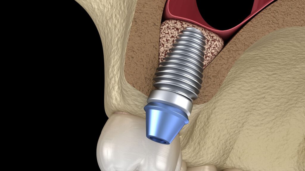 Illustration eines Zahnimplantats nach einem Sinuslift-Verfahren zur Kieferhöhlenaugmentation.
