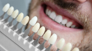 Nahaufnahme eines lachenden Mannes mit verschiedenen Zahnfarbmustern, die für Zahnersatz in Stuttgart verwendet werden.