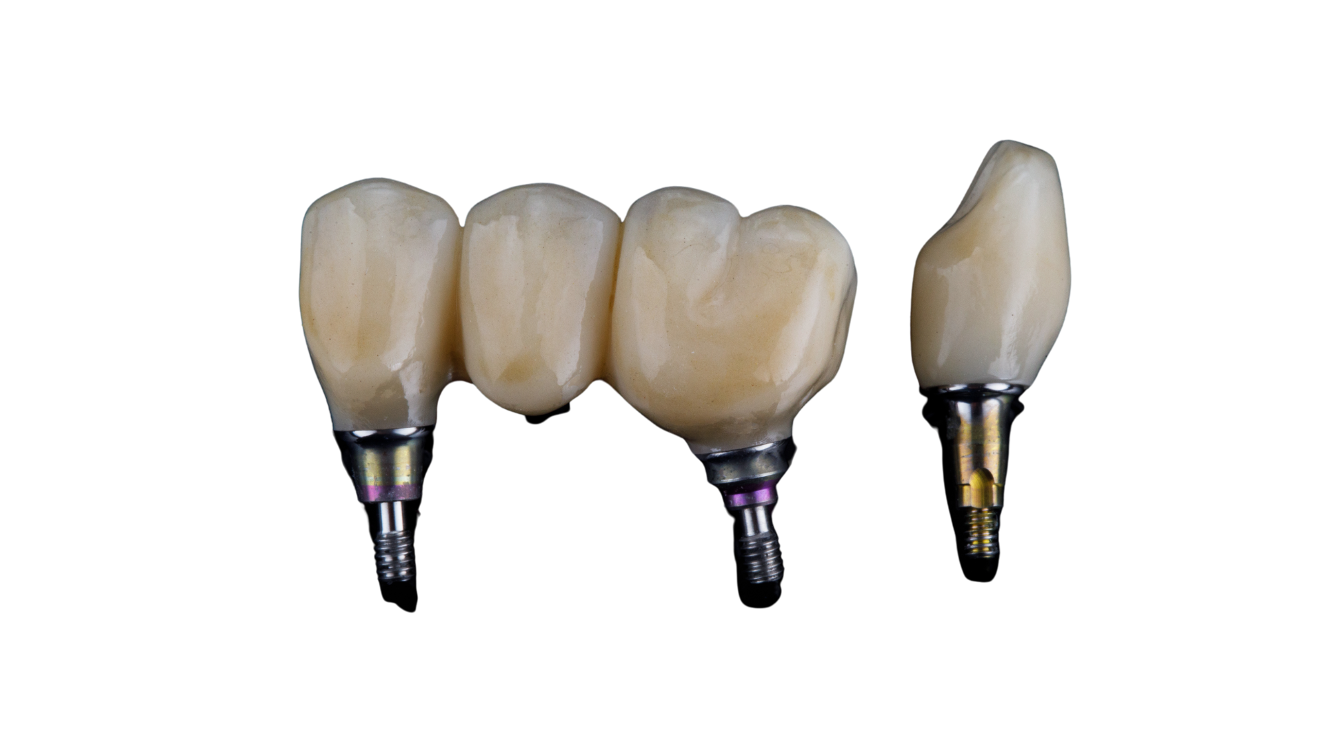 Implantat oder Zahnbrcke  Vor- und Nachteil vom Zahnersatz