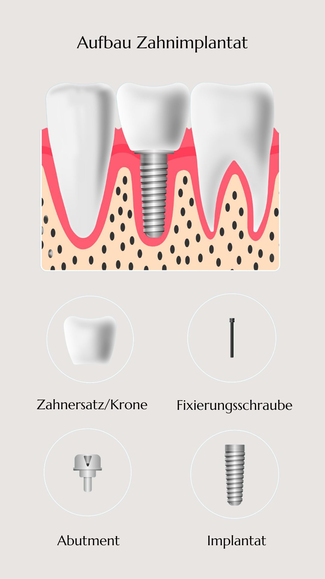 Illustration eines Zahnimplantats, das die einzelnen Komponenten zeigt: Implantat, Abutment, Fixierungsschraube und Zahnersatz/Krone.
